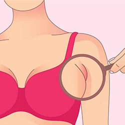 Axillary Breast Removal Surgery